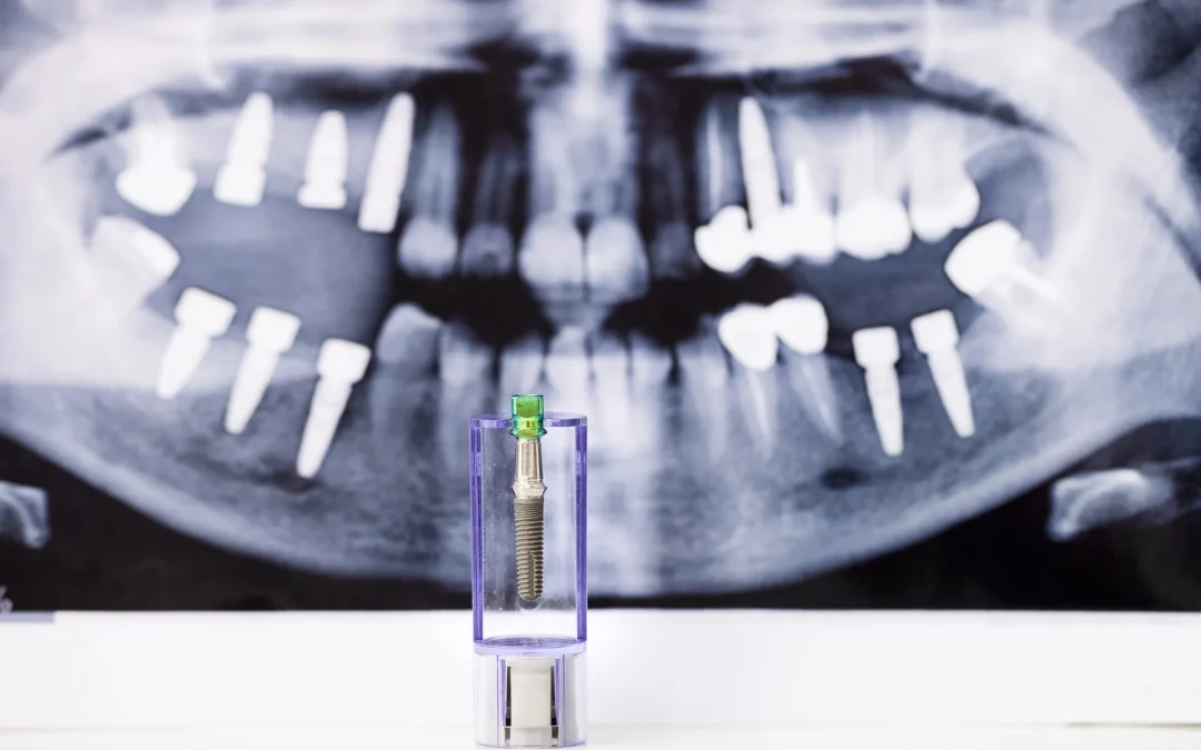 Implantologia a Carico Immediato a Favria:Denti Fissi in un Solo Intervento